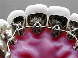 Focus on Brackets  Orthodontic Products