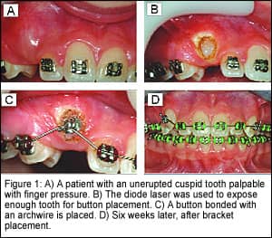 Why Do Orthodontists Prescribe Braces for Impacted Teeth?