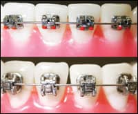 Hu-Friedy Announces Orthodontic Wire Bending Contest