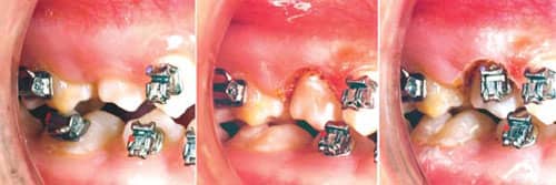 Bicuspid bracket replacement