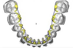 Computer model of treatment