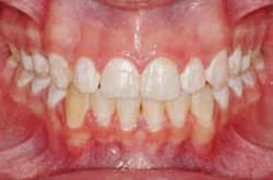 After treatment; no further damage visible