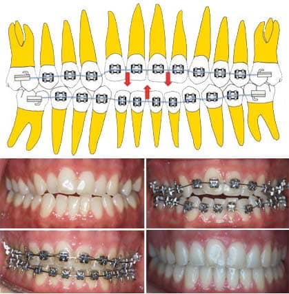 braces before and after open bite