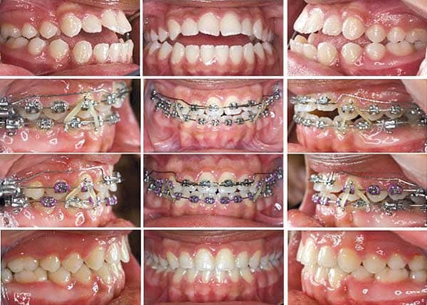 Braces Elastics (Rubber Bands) for Bite Correction and Alignment