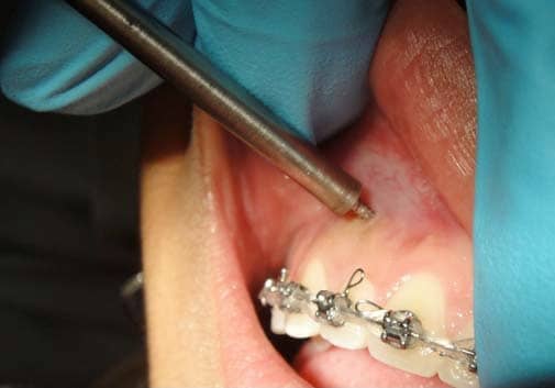 Accelerating Tooth Movement With Micro Osteoperforation Orthodontic