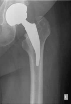 hip replacement opt