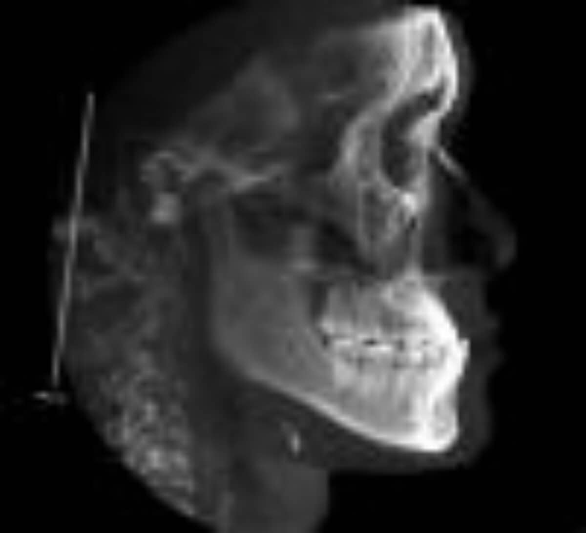 Periodontally Accelerated Orthodontics | Orthodontic Products