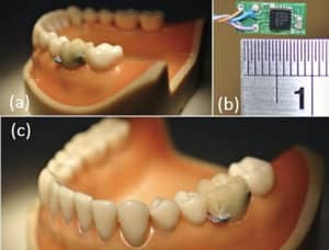 Smart Tooth Sensor Provides Patient Health Data