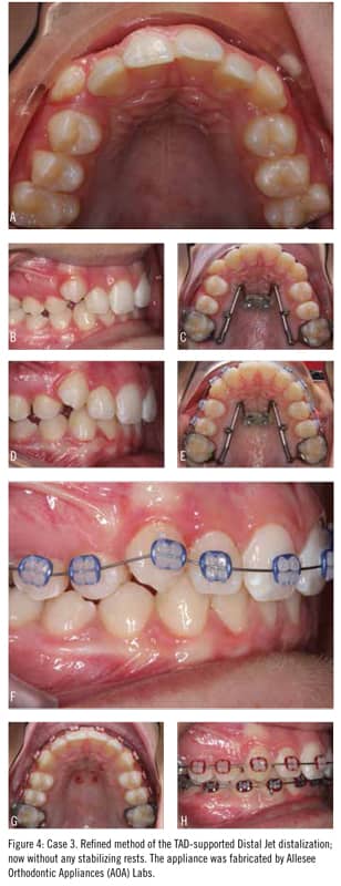 Maxillary Distalization with TADs | Orthodontic Products