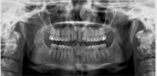 Accelerating Aligner Therapy