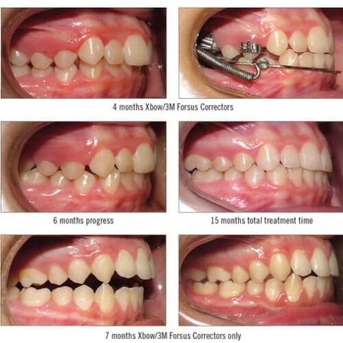 Class II Correction with Higgins Xbow and Forsus Correctors