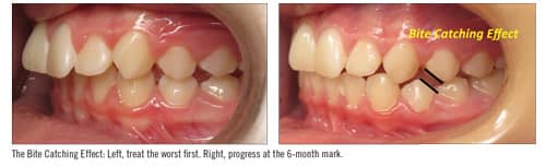 Class II Correction with Higgins Xbow and Forsus Correctors