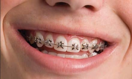 WildSmiles Offers Star DesignerBraces