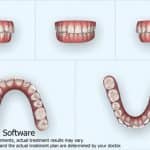 Maxillary Impaction with Aligners, TADs, and Low Pulsatile Forces