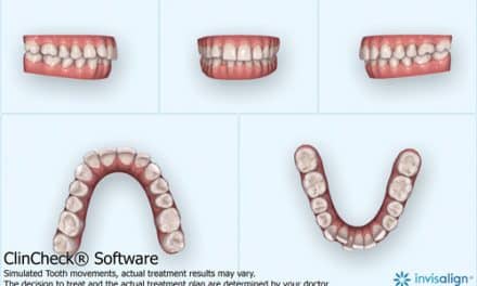 Maxillary Impaction with Aligners, TADs, and Low Pulsatile Forces