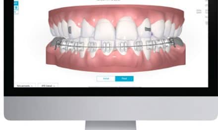 BracePaste® Adhesive  American Orthodontics