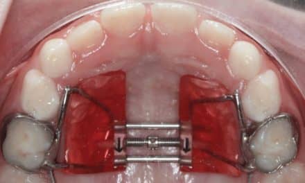 Align Technology Introduces the Invisalign® Palatal Expander