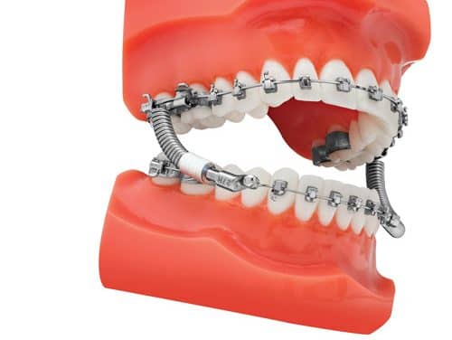 TP Orthodontics Introduces the VektorPRO Class II Corrector