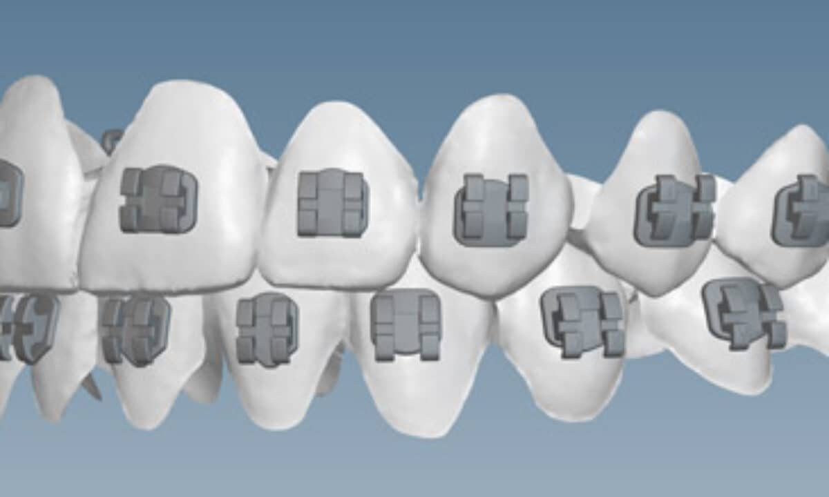 klowen braces columbus KLOwen Custom Braces System Enters Orthodontic Market