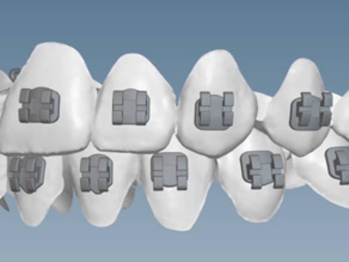 KLOwen Custom Braces System Enters Orthodontic Market