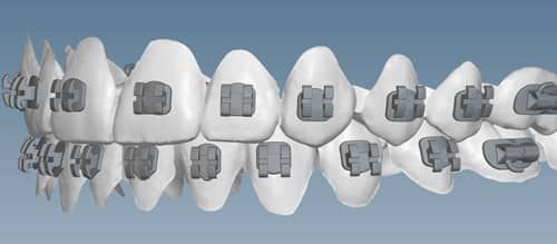 KLOwen Custom Braces System Enters Orthodontic Market