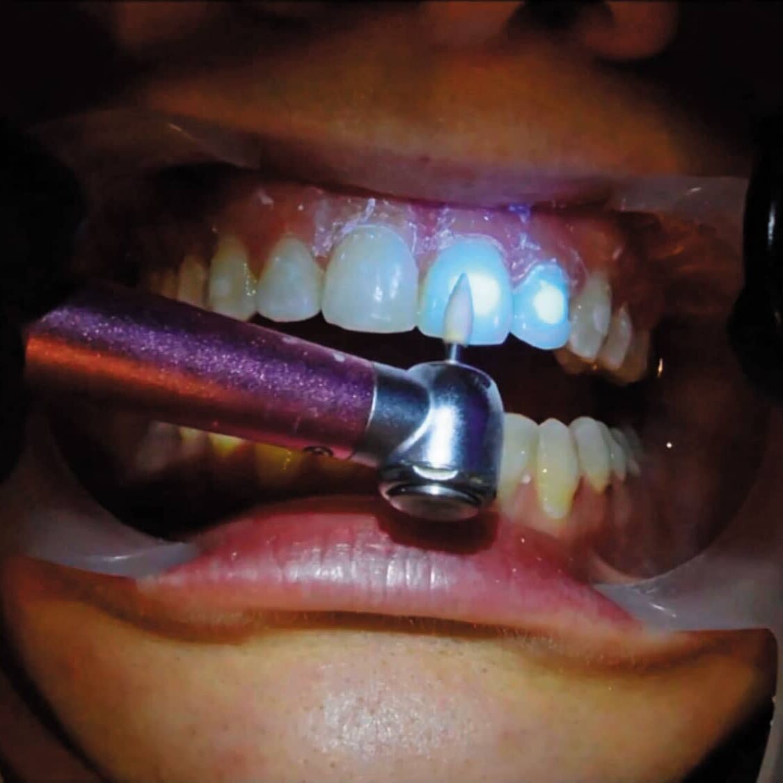 Comparing Two Orthodontic Adhesives | Orthodontic Products