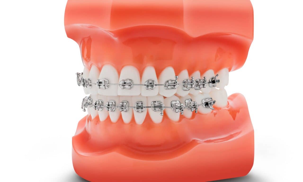 TP Orthodontics Introduces Pre-Coated Nu-Edge NX Brackets