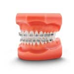 TP Orthodontics Introduces Pre-Coated Nu-Edge NX Brackets