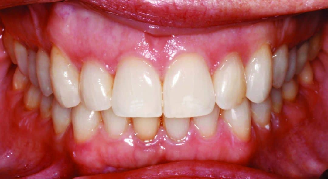 Finding the Right Aligner Brand for Your Practice Orthodontic Products