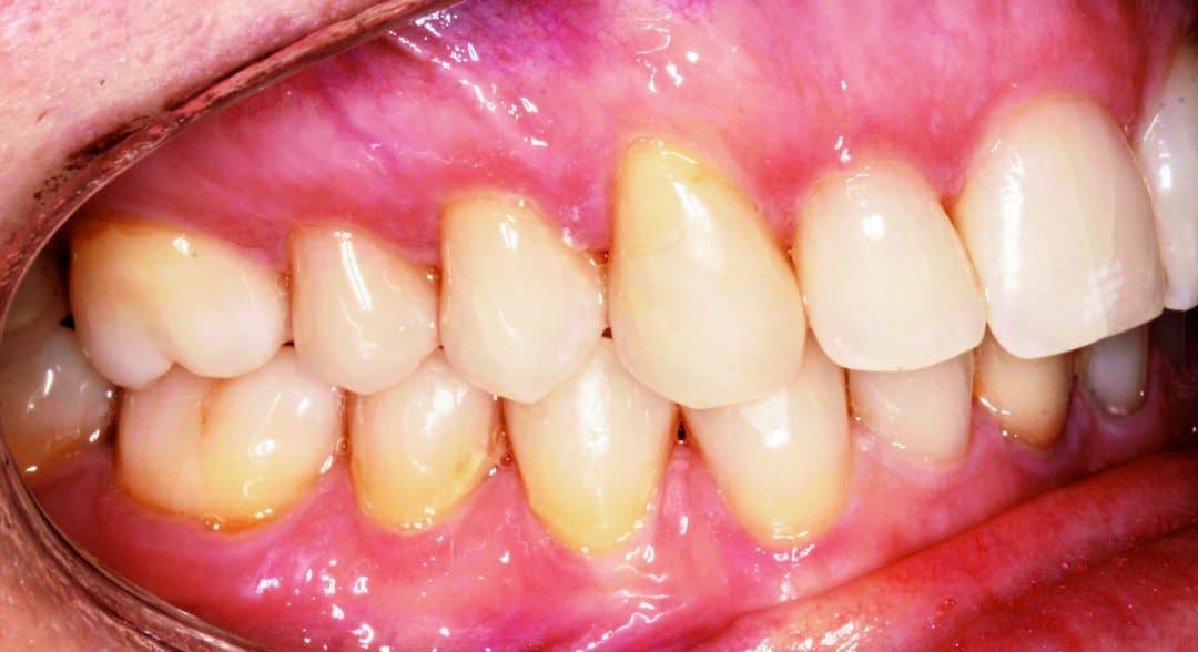 Finding the Right Aligner Brand for Your Practice Orthodontic Products