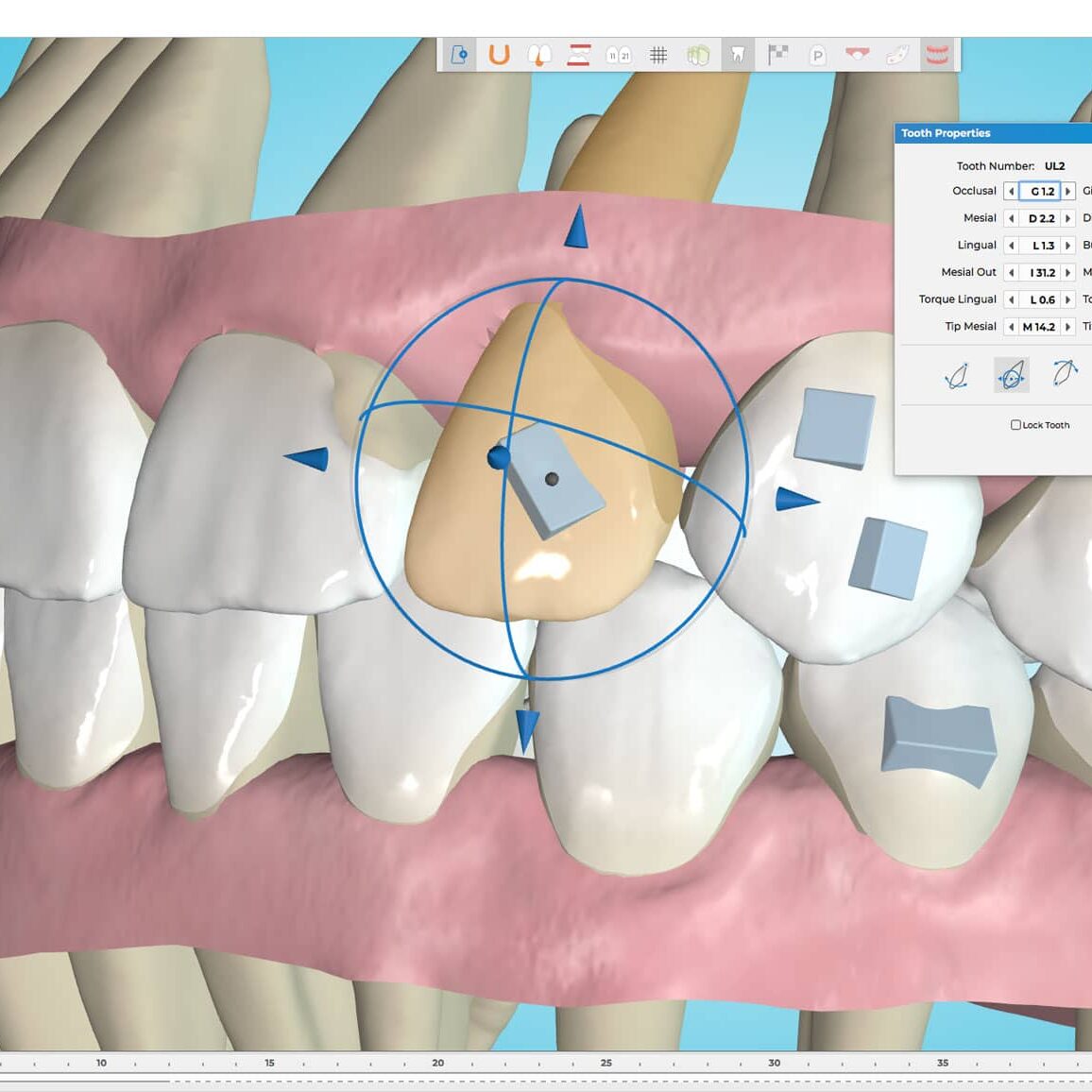 Ormco_Spark_Clear_Aligner_Appr