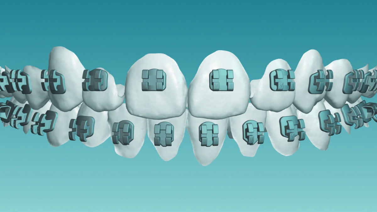 klowen braces columbus KLOwen Custom Braces | Holly Springs main image 0