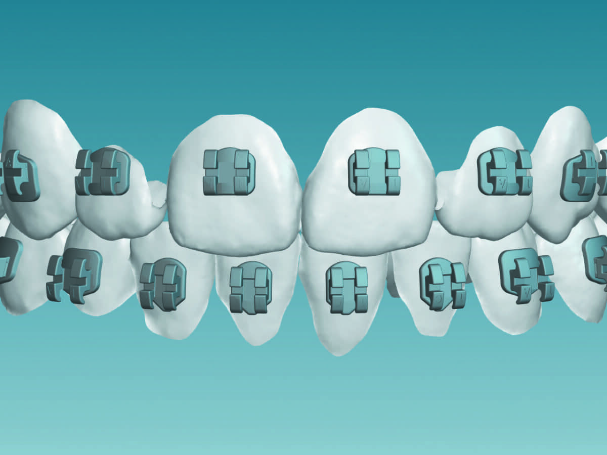 klowen braces columbus AAO Announces Investment, as Support for Orthodontic Innovation Continues Label Type:No Label Scheme representing the assimilation Magnesium Supplements