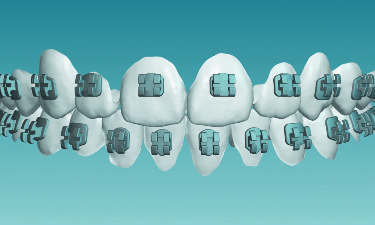 AAO Announces KLOwen Braces Investment, as Support for Orthodontic Innovation Continues