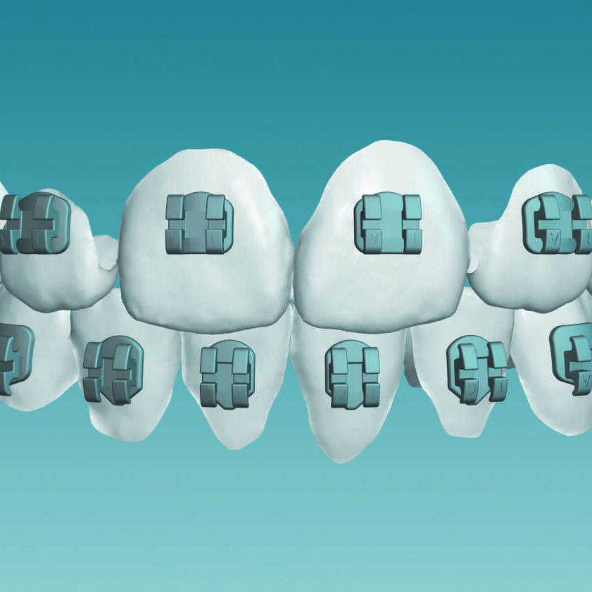 klowen orthodontics AAO Announces KLOwen Braces Investment, as Support for Orthodontic  Innovation Continues