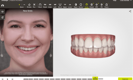 Align Technology Offers Clincheck ‘In-Face’ Visualization Tool For Invisalign Go System