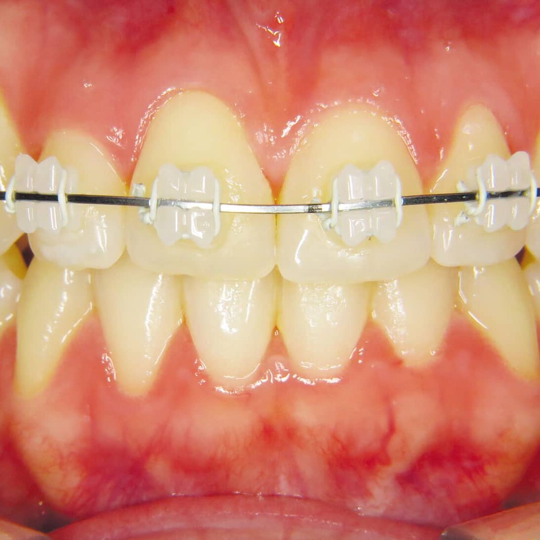 Five Factors of Ceramic Brackets | Orthodontic Products, image size:1093x1093