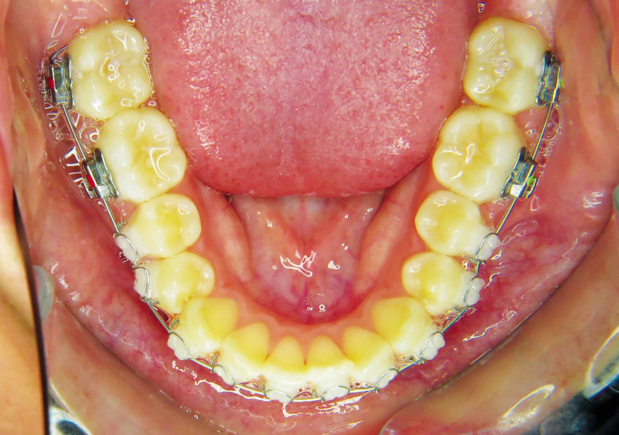 Five Factors of Ceramic Brackets Orthodontic Products