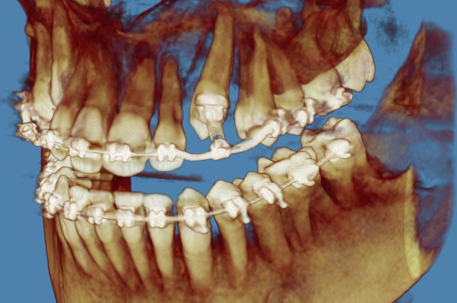 Curated visual reference: Picture Idea: Impacted Canine Treatment Springs Forward