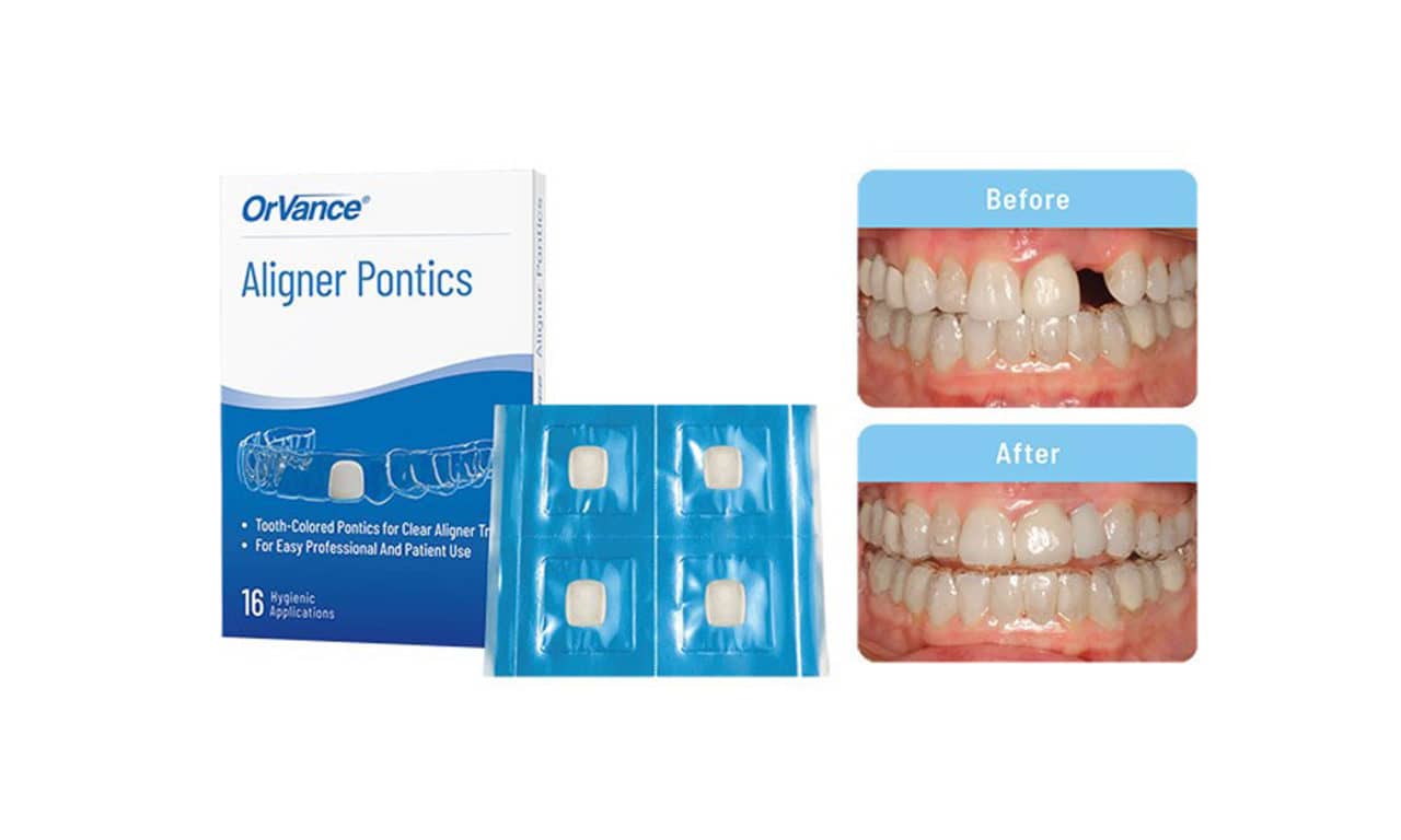 OrVance Launches Aligner Pontic Solution for Patient Use