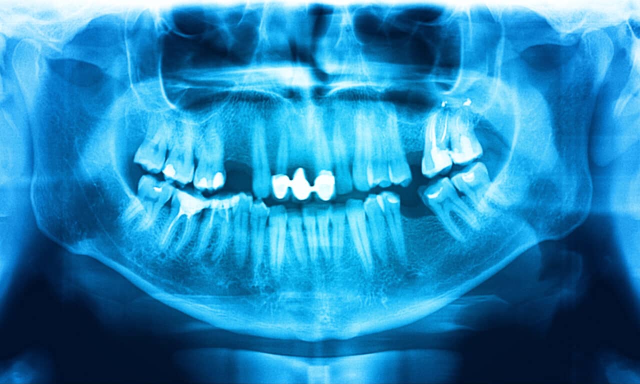 A Return to the Basics of Panoramic Radiography with Upcoming Carestream Dental Webinar