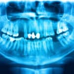 A Return to the Basics of Panoramic Radiography with Upcoming Carestream Dental Webinar