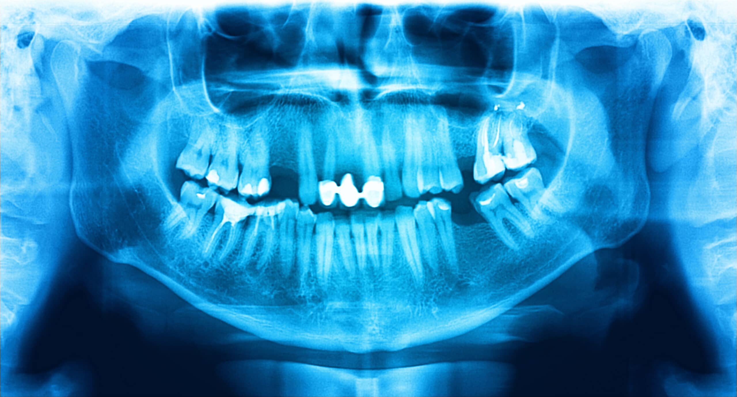 A Return to the Basics of Panoramic Radiography with