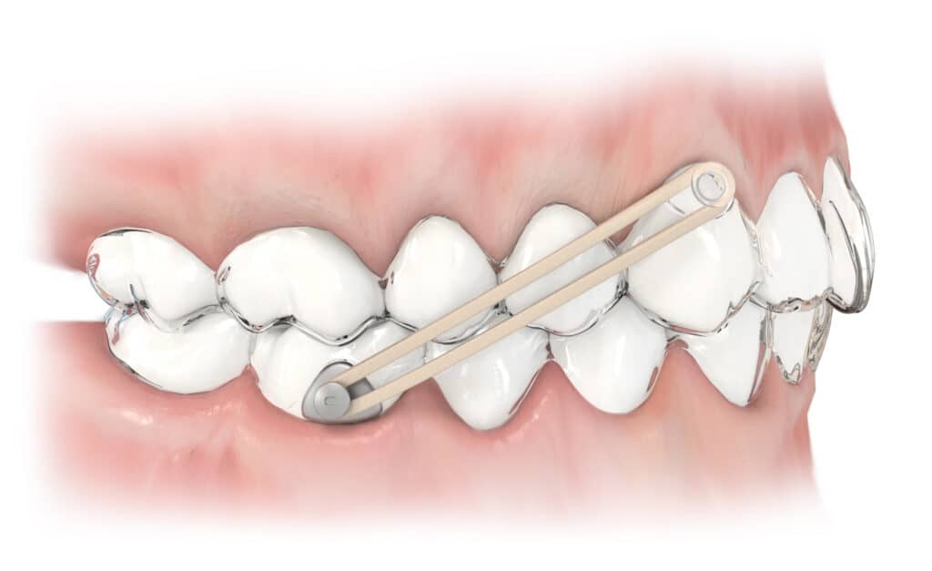 Invisalign Anchor Buttons - Centric Orthodontics