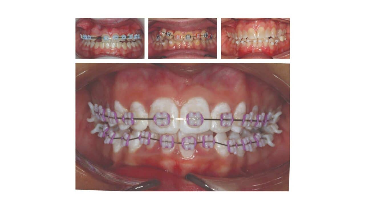 How 3D Printing Makes Hybrid Orthodontic Treatment Possible