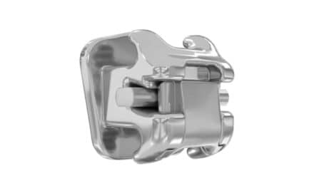 ​​Evaluating the Damon Ultima System’s New Passive Self-Ligating Bracket and Wire Design