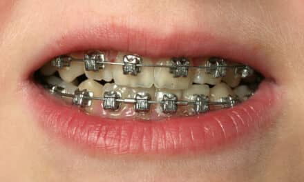 Orthodontic Wire Linked to Pediatric Appendicitis