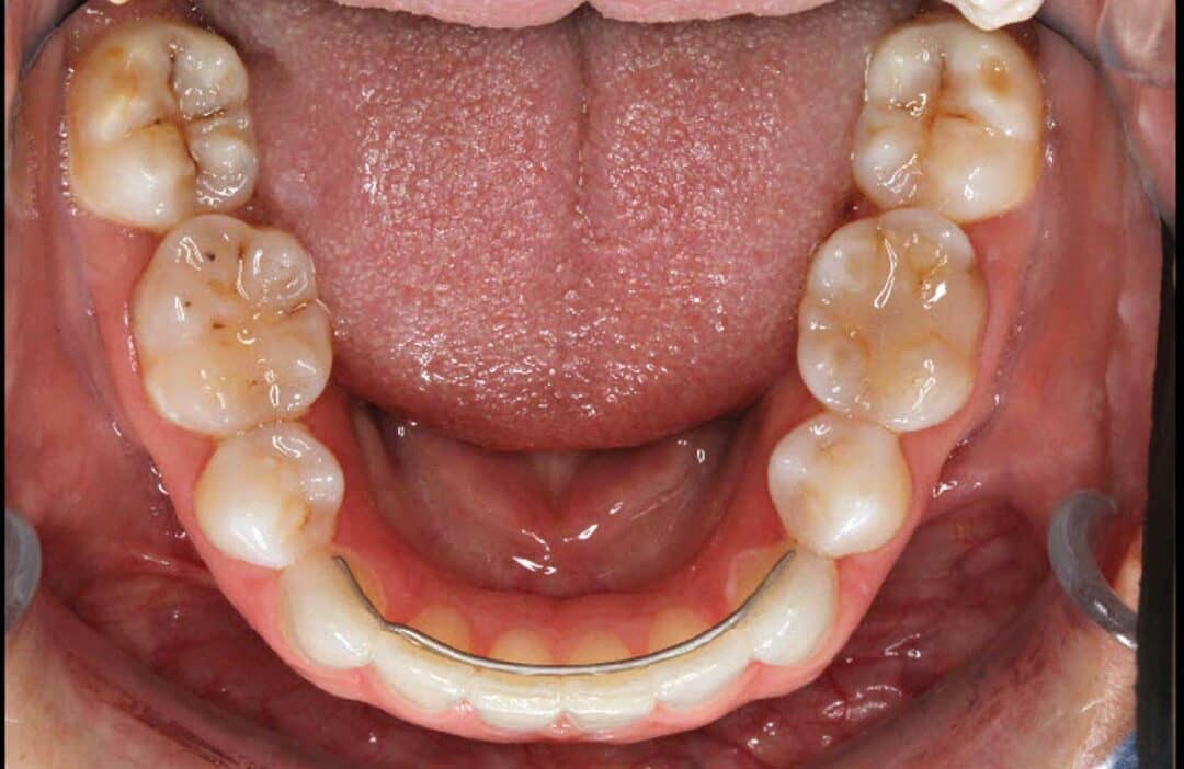 Clear Aligner Management of Adult Orthodontic Relapse Case