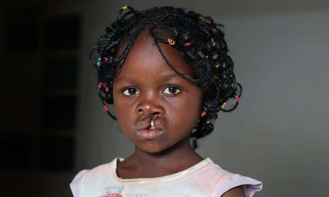 Dentsply Sirona Partners with Smile Train to Support Global Cleft Care Initiative