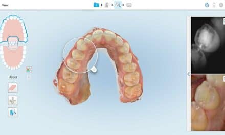 New Clinical Study Validates iTero Element 5D on Interproximal Caries Detection